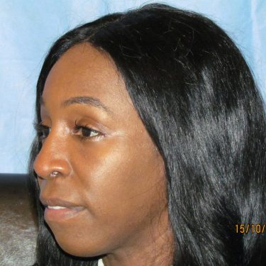 Ethnic Rhinoplasty Before and after