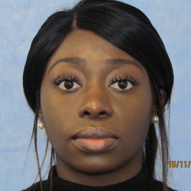 Ethnic rhinoplasty before and after