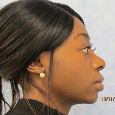 Ethnic rhinoplasty before and after