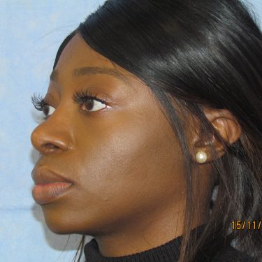 Ethnic rhinoplasty before and after