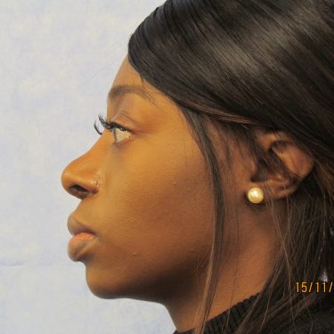 Ethnic rhinoplasty before and after