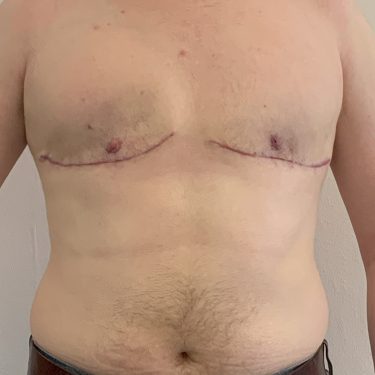 Female to Male TOP Surgery Front View