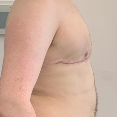 Female to Male TOP Surgery right side View