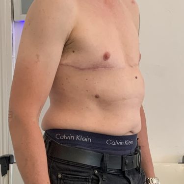 Female to Male Transgender (TOP) Surgery right quarter view