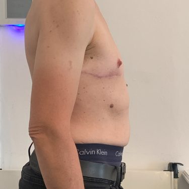 Female to Male Transgender (TOP) Surgery right lateral view