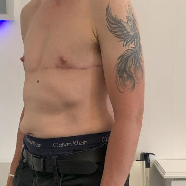 Female to Male Transgender (TOP) Surgery left quarter view