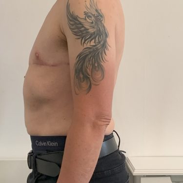 Female to Male Transgender (TOP) Surgery left lateral view