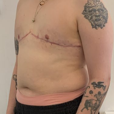 Female to Male TOP surgery left quarter view 