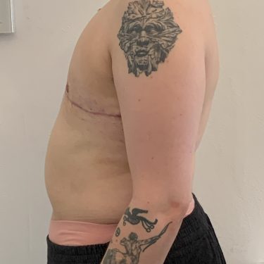 Female to Male TOP surgery left side view 
