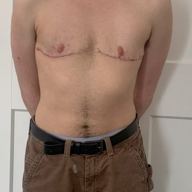 Female to Male TOP Surgery Front View