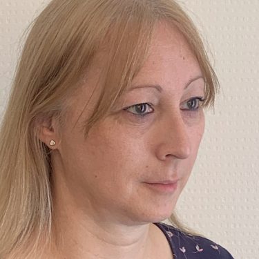 Brow Bone Reduction Right Quarter View