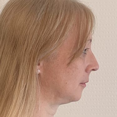 Brow Bone Reduction Right Lateral View