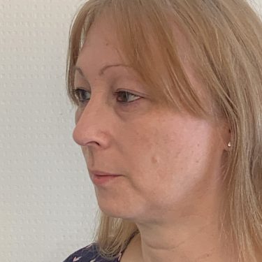 Brow Bone Reduction Left Quarter View