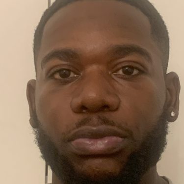 Ethnic rhinoplasty before and after