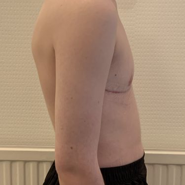 Before and after TOP Surgery