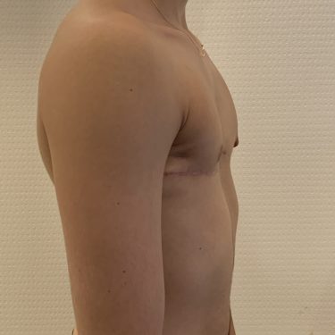 Before and after TOP Surgery