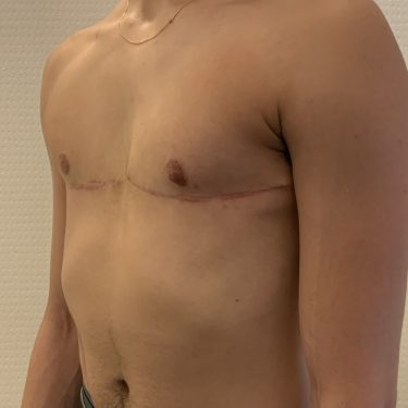 Before and after TOP Surgery