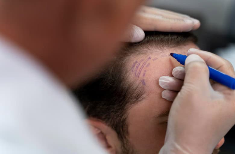 Hair transplant