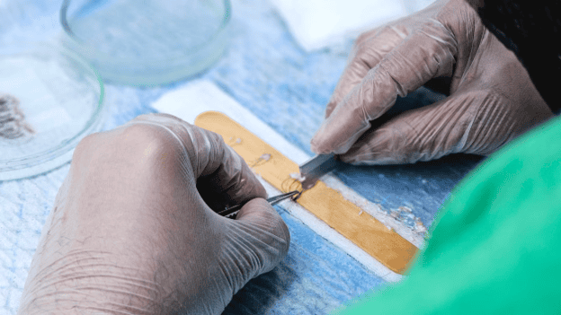 Hair transplant